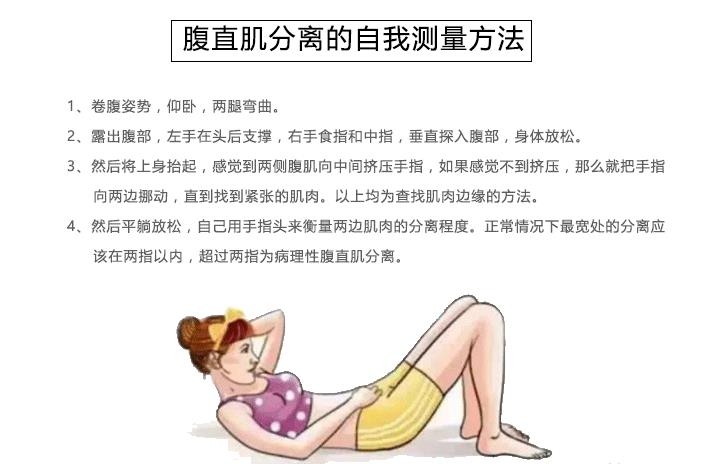 腹直肌分離 腹直肌分離
