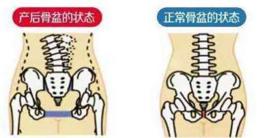骨盆修復 骨盆修復