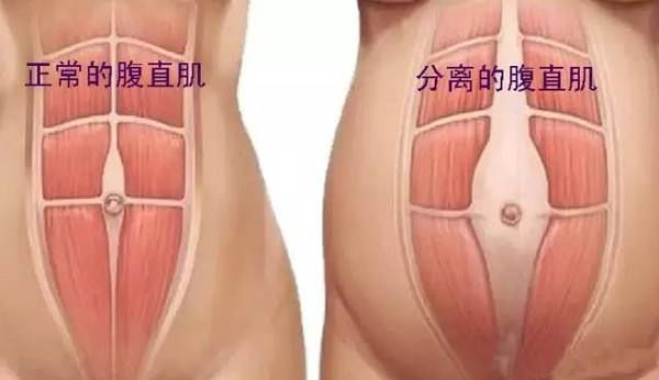 腹直肌分離 腹直肌分離