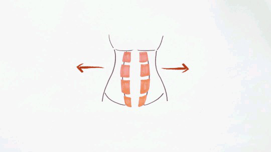 腹直肌分離 腹直肌分離