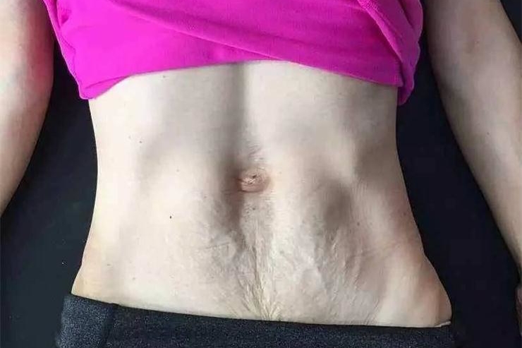 1560933503295456.jpg 腹直肌分離