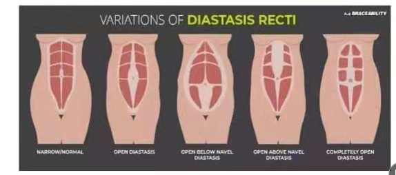 1563435012625009.png 腹直肌分離