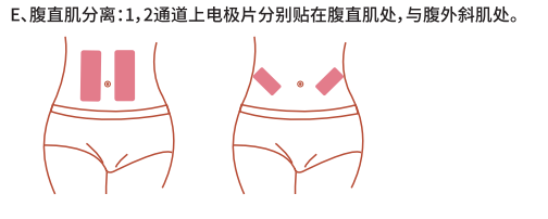 1563865997352285.png 腹直肌修復