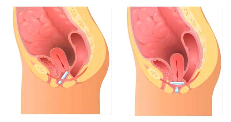 1564477897215423.jpeg 子宮脫垂盆底康復治療