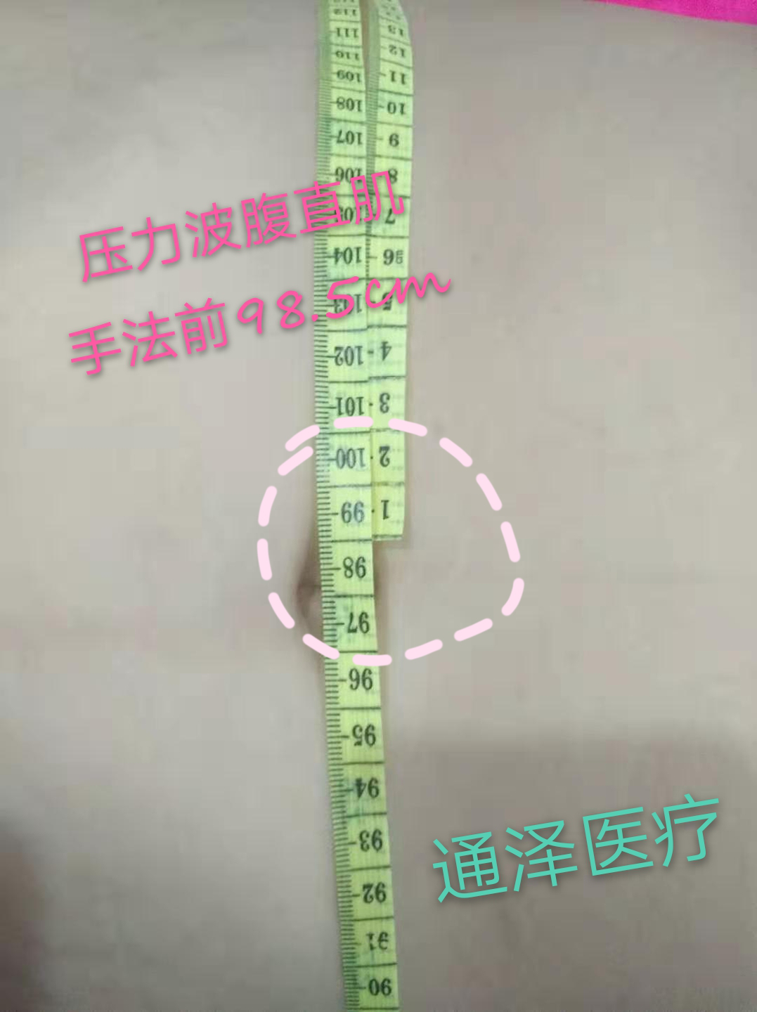 1565322947527745.png 腹直肌分離