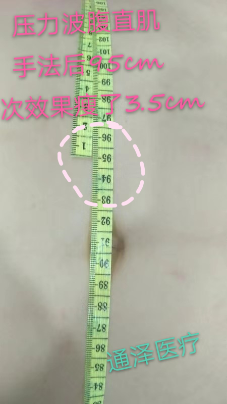 1565322955231652.png 腹直肌修復