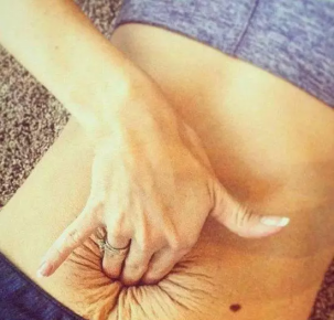 1568947018387683.png 腹直肌修復