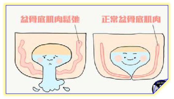 產(chǎn)后盆底康復