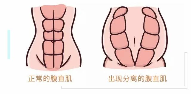 1572419633459276.png 產(chǎn)后腹直肌修復