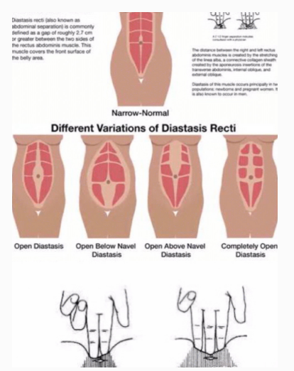 1576204436965498.png 產(chǎn)后腹直肌分離