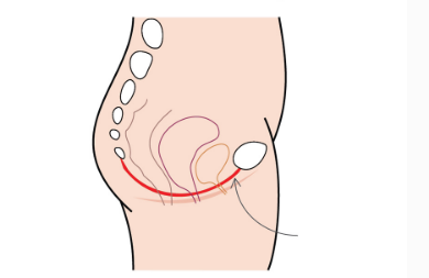 1576485464684663.png 腹直肌康復