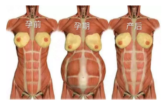 1579153718733893.png 腹直肌修復