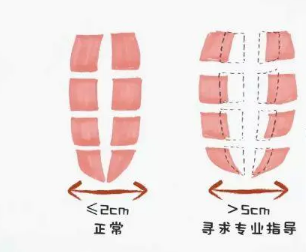 1605062948857833.png 腹直肌修復